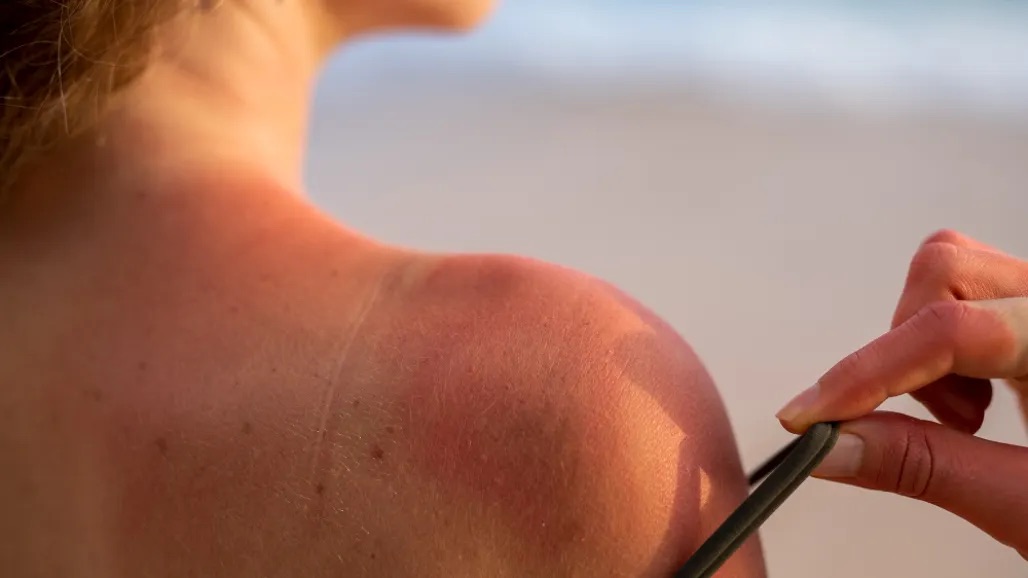 Tomar mucho tiempo el sol sin protección puede provocar cáncer de piel